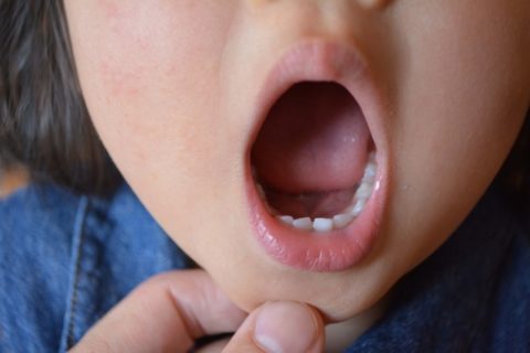 口内炎が痛いときの治し方！原因と予防の方法